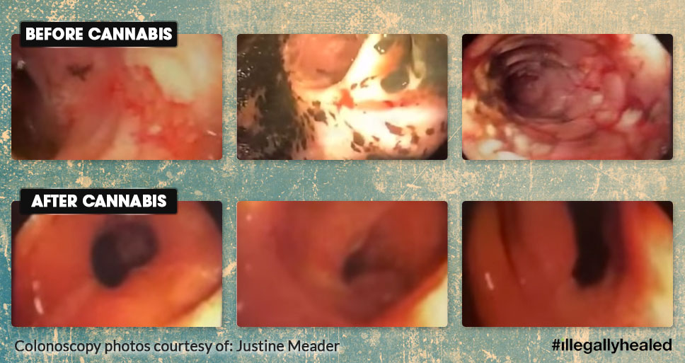Colonoscopy Before and After Juicing Raw Cannabis