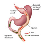 Illustration of gastric bypass surgery.