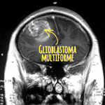 Example: Coronal MRI with contrast of a glioblastoma.