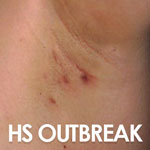 HS outbreaks are painful in tender areas and may persist for years.